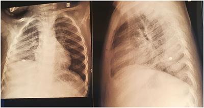 The Association Between Mycoplasma pneumoniae and Chlamydia pneumoniae, a Life-Threatening Condition in Small Children—A Case Report and a Review of the Literature